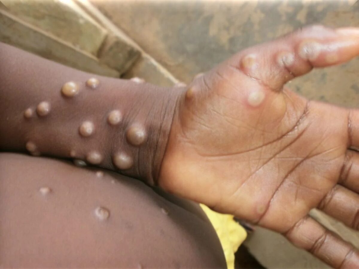 WebRNS Monkeypox Infection1
